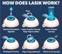 LASIKSurgery_Diagram