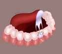 cavity