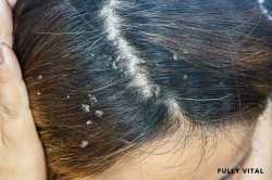 dermatitis-on-scalp_2044x