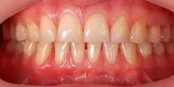gums
