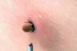 dog-tick-in-human-skin
