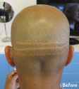 Hair-Transplant-Scars-before