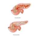 Acute-and-Chronic-Pancreatitis