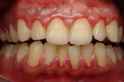 gumdisease