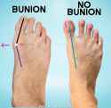 Bunion-versus-healthy-foot-demonstration-copy-e1667408122874-1024x996