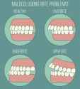 illustrations+of+malocclusions