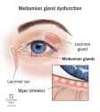 meibomian-gland-dysfunction