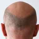 norwood-scale-7-real-example-back-of-head