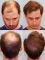 5000 grafts before and after.jpg