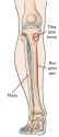 a00407f01_lower-leg-anatomy_shin_splint_kh-compressor