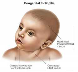 torticollis