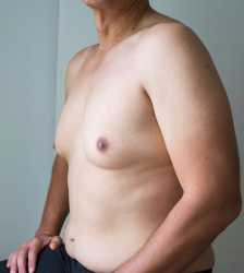 gynecomastia