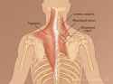 trapezius-rhomboid-levator