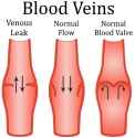 venous-leak-diagram