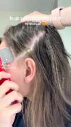 Scalp Psoriasis