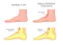 Tibialis-Anterior-Tendonitis-1024x732