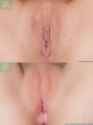 clitoridectomy-inner-labia-removal-before-and-after