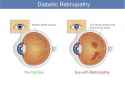 Diabetic_retinopathy