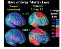 gray matter loss