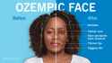 ozempic-face