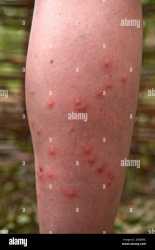 mosquito-bites-on-human-leg