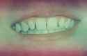 teeth2