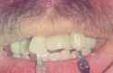 teeth3