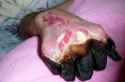 2-dry-gangrene-caused-by-the-plague-cdc