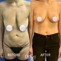 breast-lift-beverly-hills-1-1024x1024