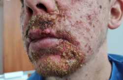 A-Honey-colored-crusts-localized-on-patients-face-due-to-secondary-bacterial-infection