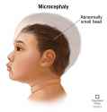 9843-microcephaly