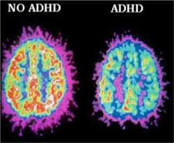 adhd-brain-pet-scan-differences-1024x845