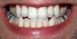 teethsmile