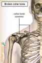 shoulder-clavicula-fracture-broken-collar-bone