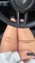 kiss shaped bruise
