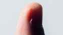 hangnail