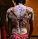 acne-back-scarring-2463