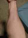 forearm
