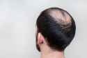 Balding-in-Men-157727984