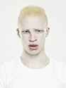 headshot-of-a-young-albino-man