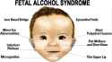 fetal-alcohol-syndrome