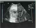 ultrasound