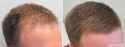 finasteride