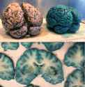 Gross_pathology_of_normal_brain_and_brain_of_patient_treated_with_methylene_blue_before_death