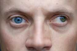 Strabismus-Blindness_G_1364573183-4130476034